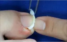 コットンパッキング