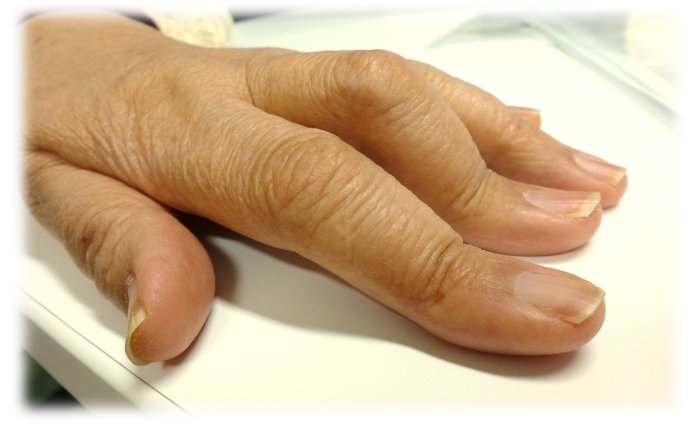 関節リウマチでみられる手指の変形